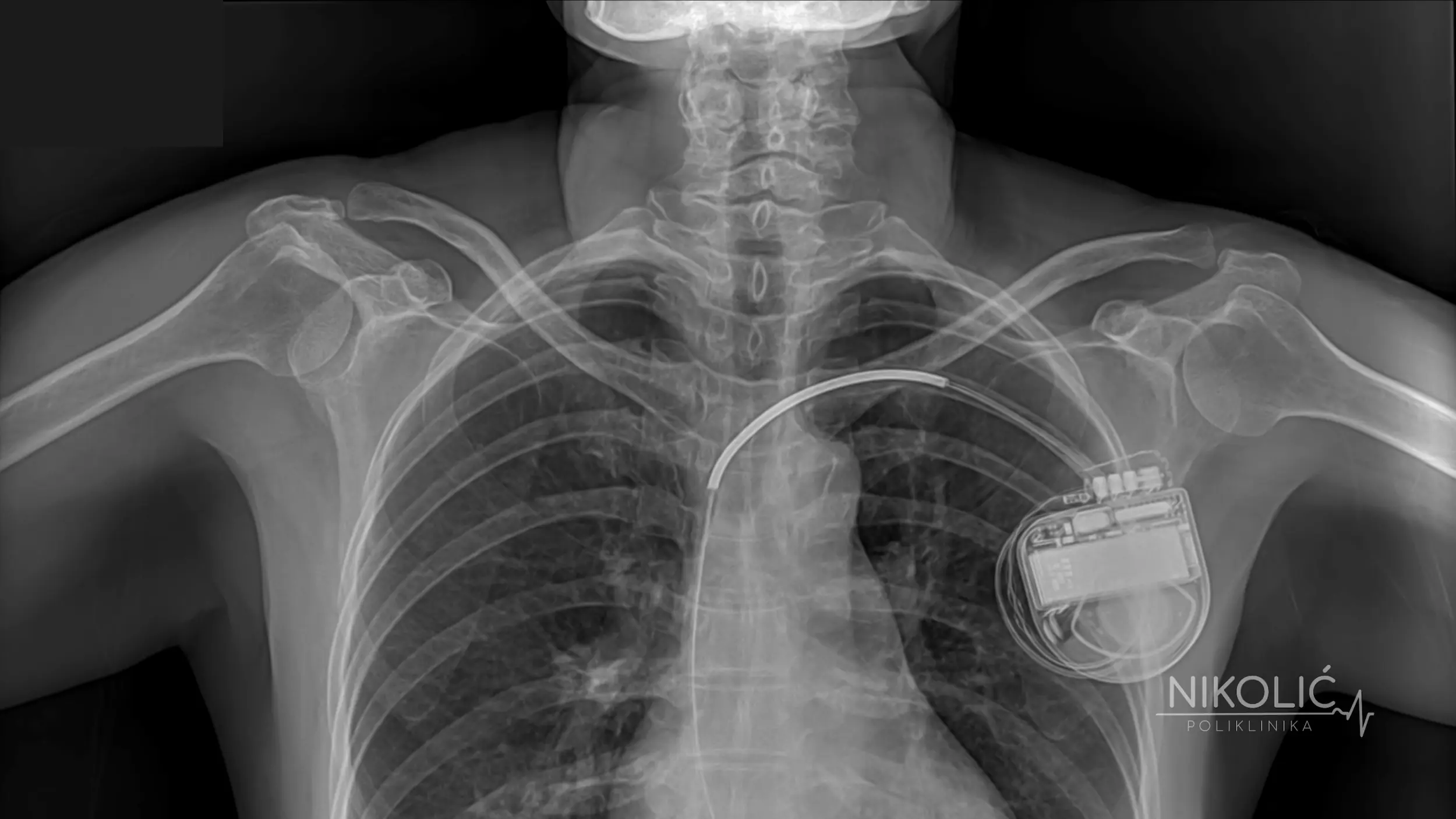 pejsmejker-ugradjen-xray-snimak